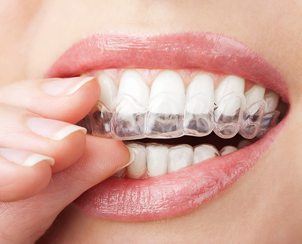 Aligning Chronicles: The Art of Invisalign