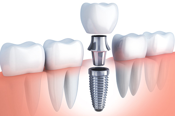 Dental Implants for Full Mouth Restoration: Regaining Confidence and Functionality in Mitchell, SD