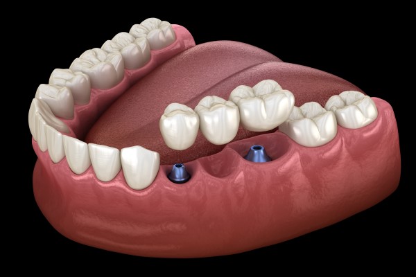 Smile Restoration: The Versatility of Dental Bridges